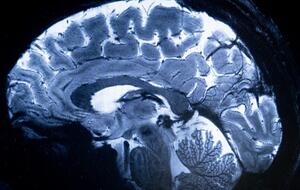Cerveau durant un IRM
